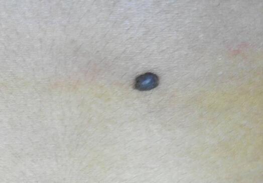 痣上长毛是好事还是坏事