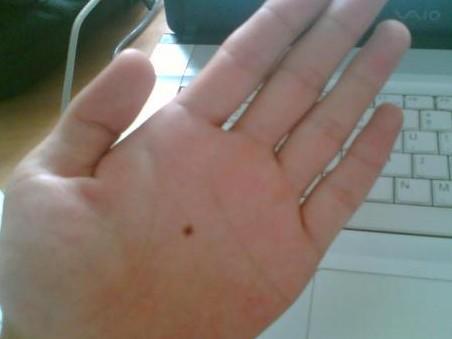 掌心痣的位置与命运（掌心痣代表意思）