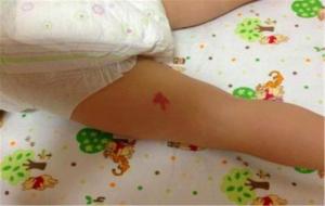 胎记是前世留下的印记