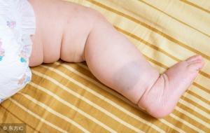 胎记地方的好坏说法(胎记位置含义)