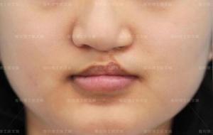 面相中各处的疤痕都有什么含义